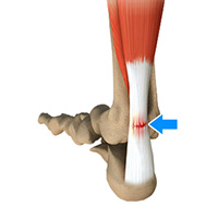 Achilles Tendon Rupture