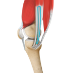 ACL Reconstruction Procedure of Hamstring Tendon