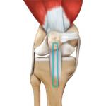 ACL Reconstruction of Patellar Tendon