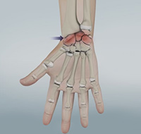 Arthritis of the Hand and Wrist