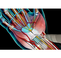 Carpal Tunnel Release Surgery