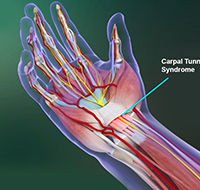 Carpal Tunnel Syndrome