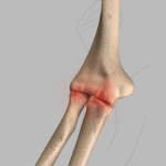 Elbow Arthritis