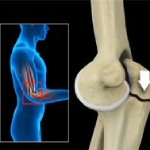 Elbow Fractures