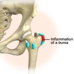 Hip Bursitis