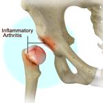 Inflammatory Arthritis