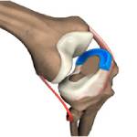 Meniscal Surgery