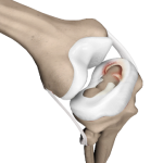 Meniscal Tear