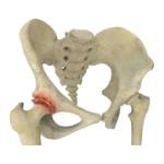 Osteoarthritis of the Hip