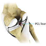 PCL Injuries