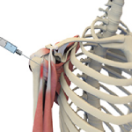 Ultrasound-Guided Shoulder Injections